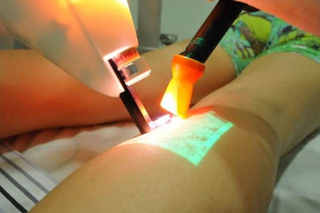 O laser é um tratamento inovador, menos dolorido e que pode evitar uma cirurgia